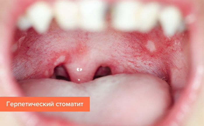 Stomatitis på tandkødet. Behandling, salve til et barn, voksne