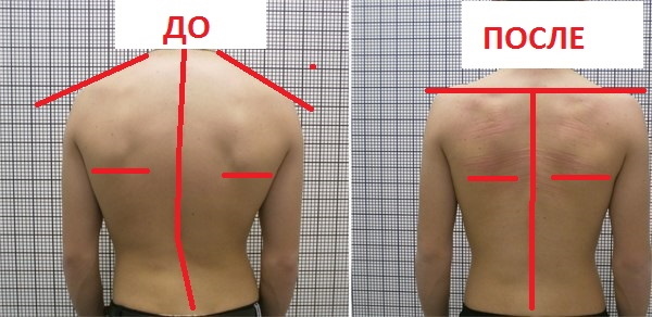 Back hump. Photos, reasons how to get rid