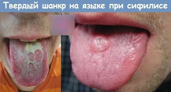 Sífilis en la cara. Foto de erupciones, como se ve
