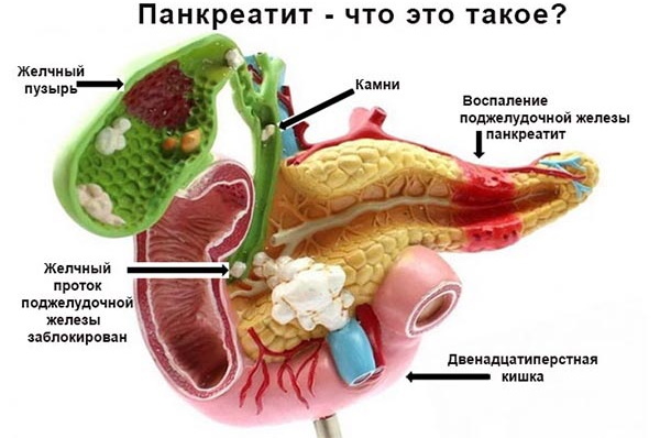Behandling af pancreatitis hos voksne med medicin, medicin til droppere, urter, kost