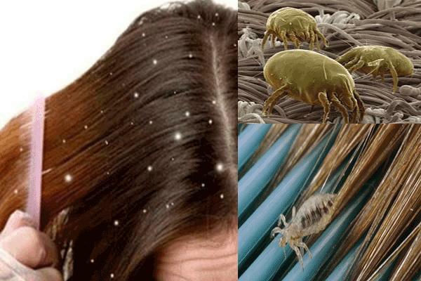 How to get rid of lice on your head?