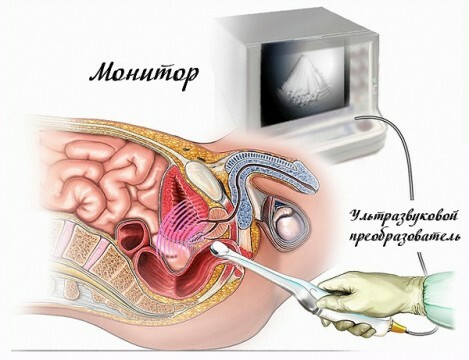 Transrectale echografie