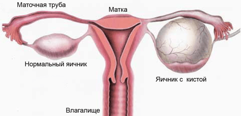 Representação esquemática do ovário com cisto