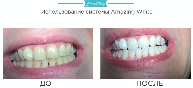 Amazing White whitening. Reviews, what is it, where to buy, before and after photos