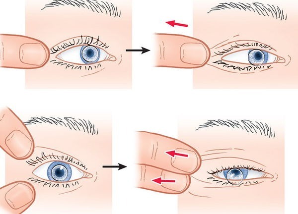 How to get a lens out of the eye if it has gone under the eyelid, stuck