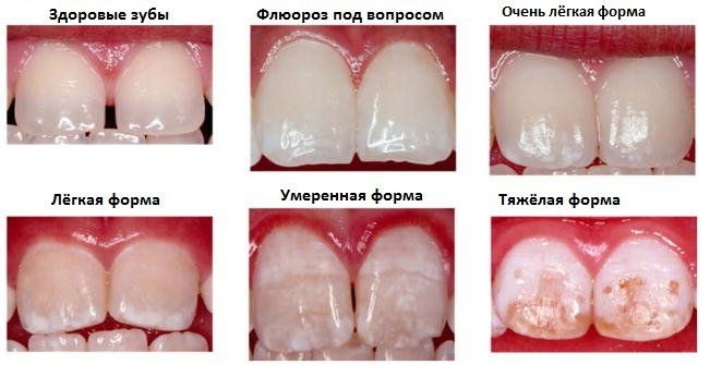 Vita scale of teeth colors. Photos, shades by numbers