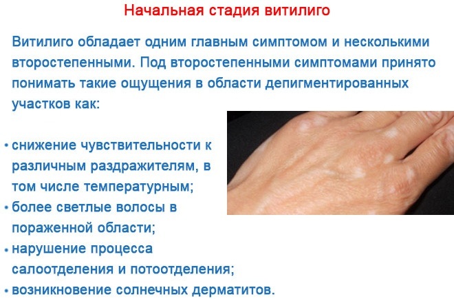 Vitiligo. Causes and treatment. What is this disease, photos, signs. Folk remedies, how to get rid