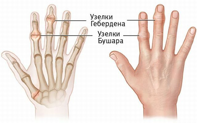 Causes, symptoms and treatment of osteoarthritis of the fingers