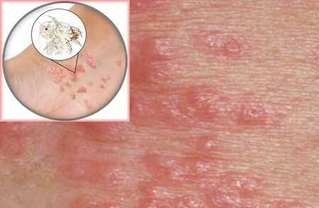 Treatment of scabies in adults