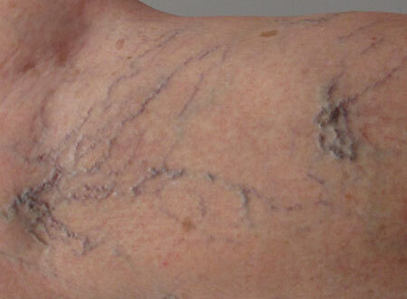 Clinical symptoms of varicose veins, photo 2