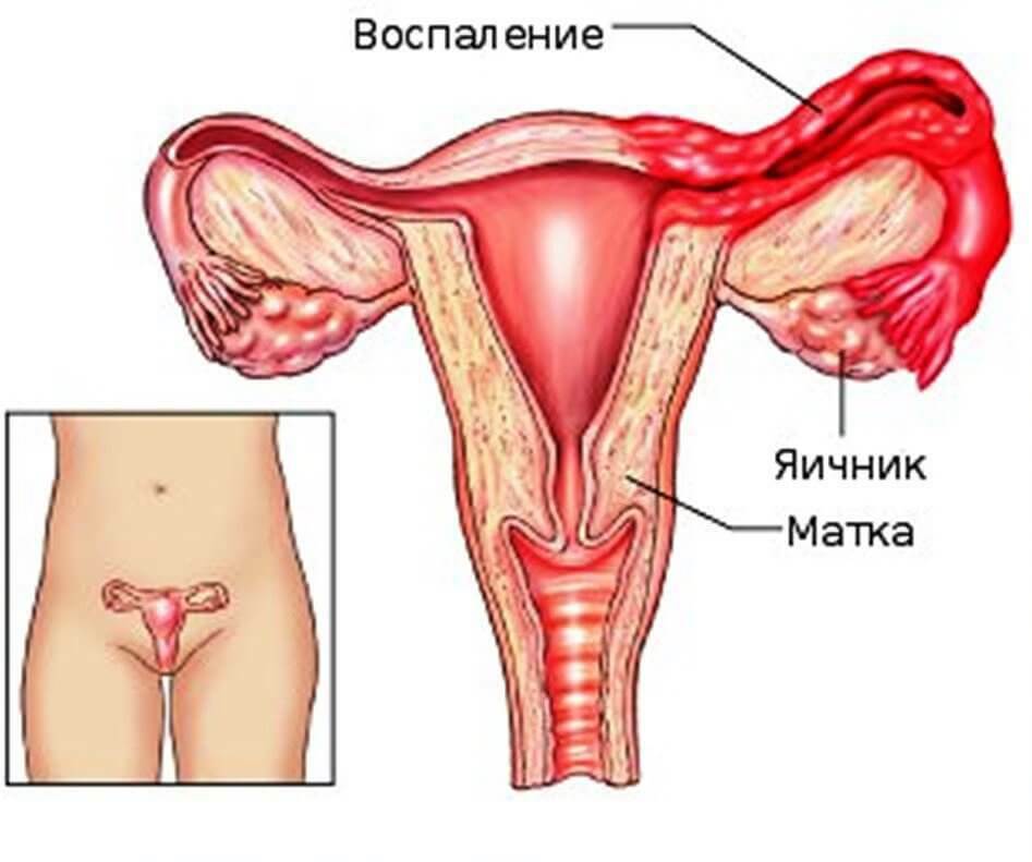 Inflammation des appendices chez les femmes