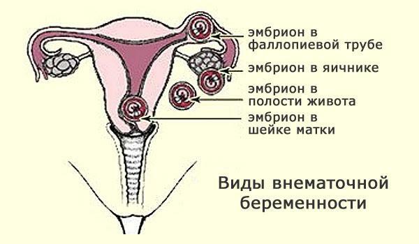 Arten der Eileiterschwangerschaft