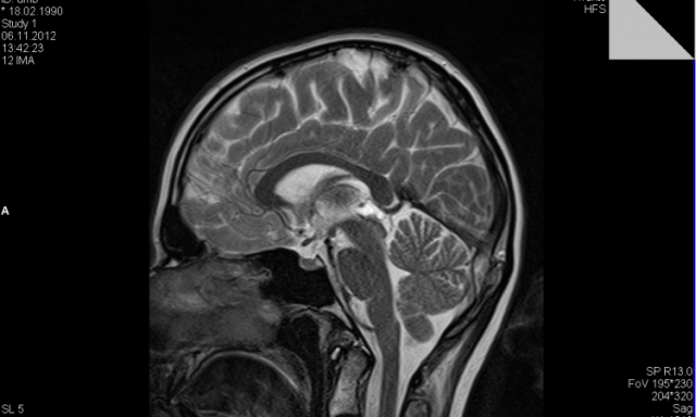 cerveau avec kyste