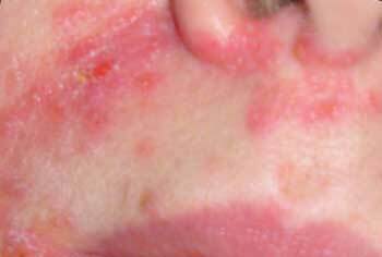 Allergisk dermatitis hos børn