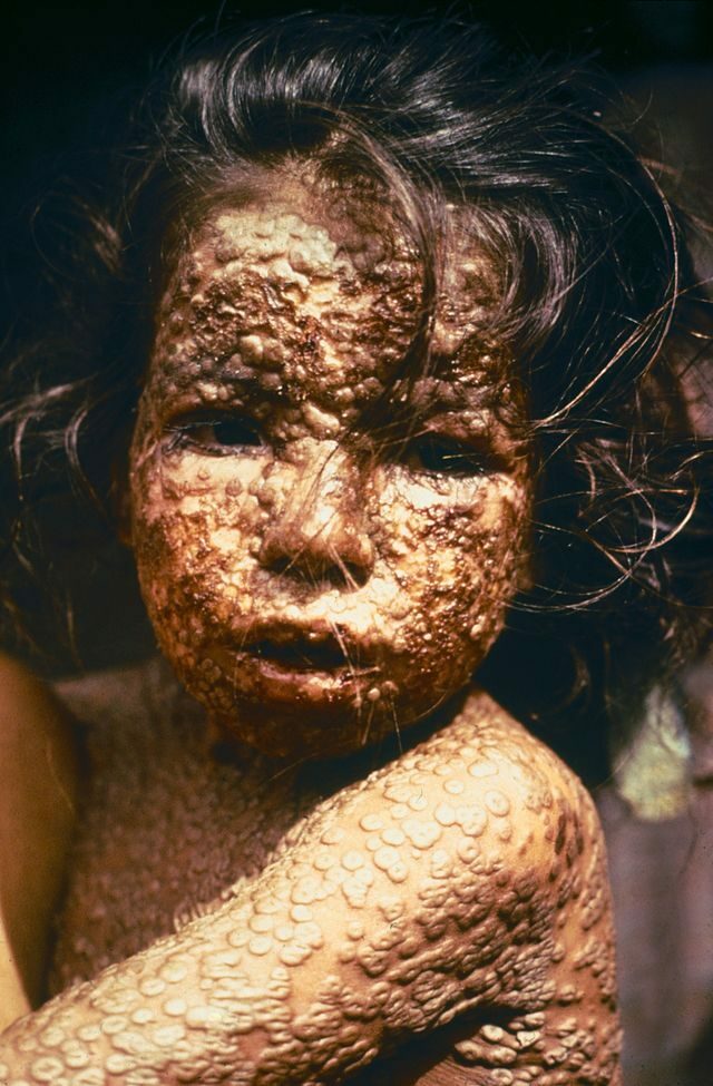 Rash with smallpox
