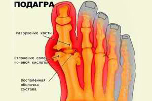 treatment of gout