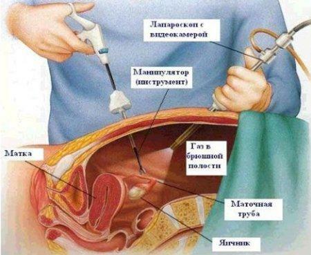 Laparoskopie für Eileiterschwangerschaft