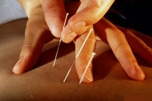 Feelings with acupuncture