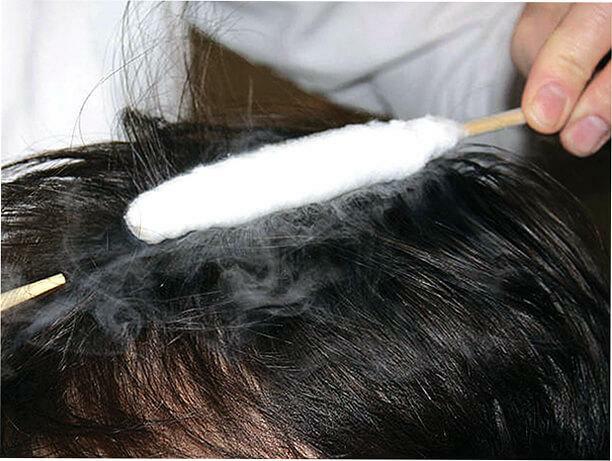 Krioterapija gali žymiai padidinti mikrocirkuliaciją plaukų folikuluose