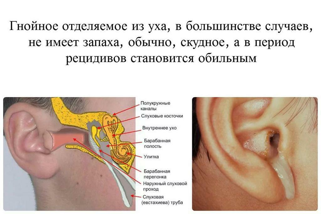 Discharge from the ear with otitis