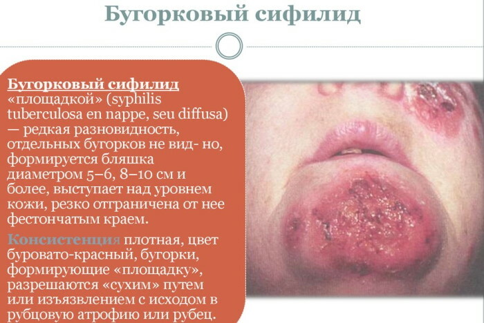 Syfilis i ansigtet. Foto af udslæt, hvordan det ser ud