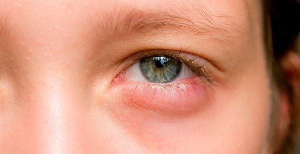 Blepharitis Treatment, drops, ointments, drugs for adults, children