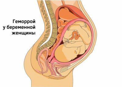 Blood from the anus during pregnancy: what to do?