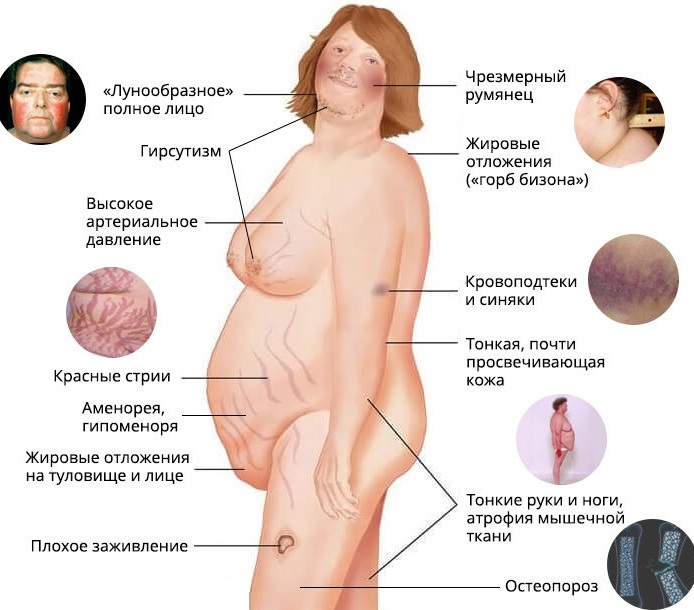 Adrenal glands hyperfunction and hypofunction. Table, symptoms of the disease, treatment of the disease