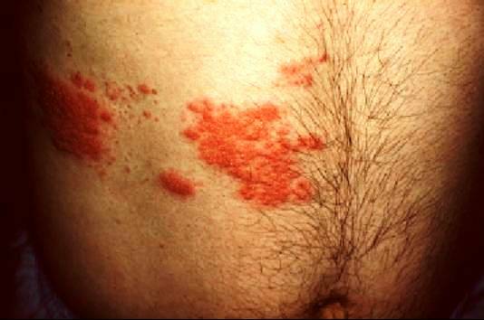 Ringworm with reduced immunity