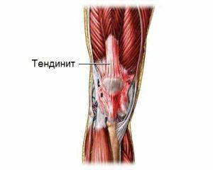 tendonitis on the knee