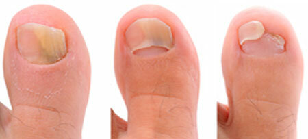 stages of development b symptoms of fungal nail injury