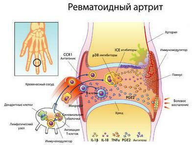 Cartaz fotográfico da artrite reumatóide