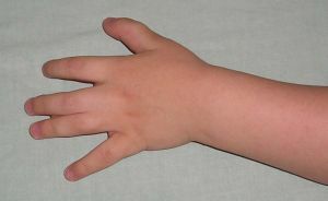 child syndactyly