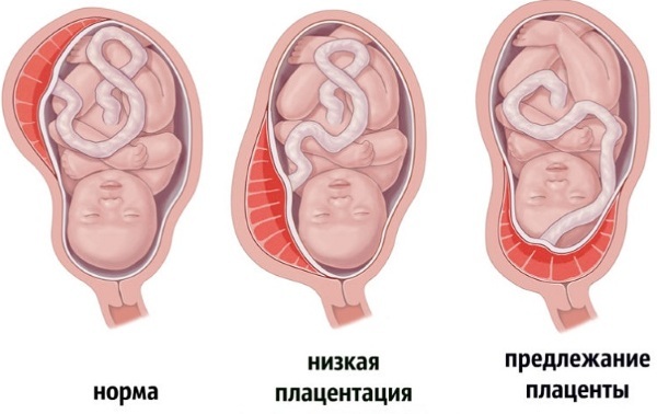 Baixa placentação durante a gravidez 12-19-20-21 semanas. O que isso significa