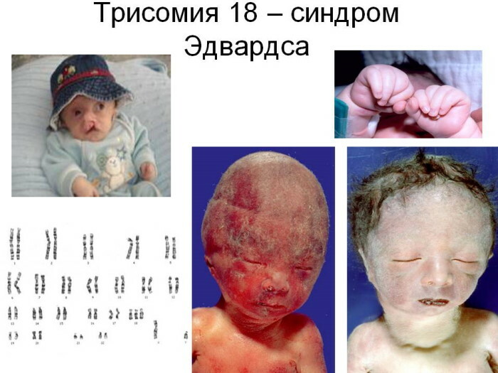 Trisomia 21.18.13: ensimmäisen raskauskolmanneksen transkription normi raskaana oleville naisille