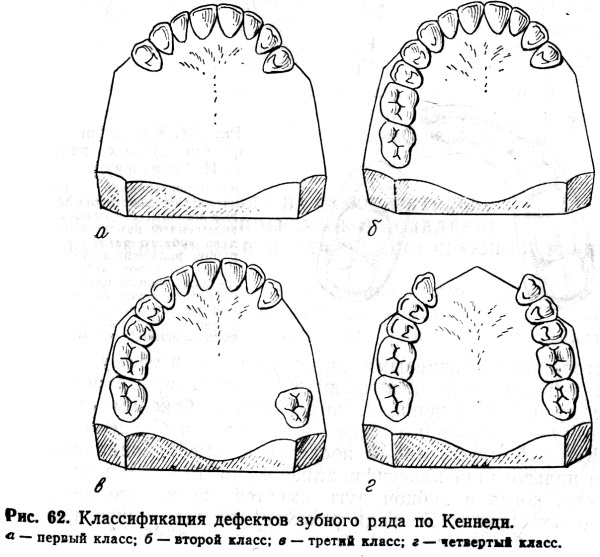 Classificação de Kennedy dos defeitos da dentição. Ortopedia