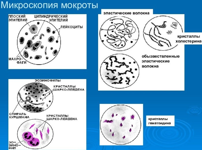 Sputum analysis. How to take for KUM, VK, BC, tuberculosis, pneumonia, what is it, the norm, decoding