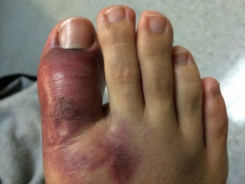 Fractura del dedo gordo del pie. Síntomas, cuánto sana, cómo curar, si es necesario un yeso, rehabilitación.