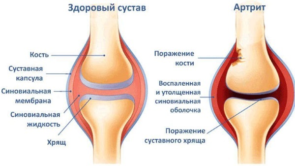 Enfermedades de la articulación de la rodilla. Síntomas, causas, tratamiento, clasificación.