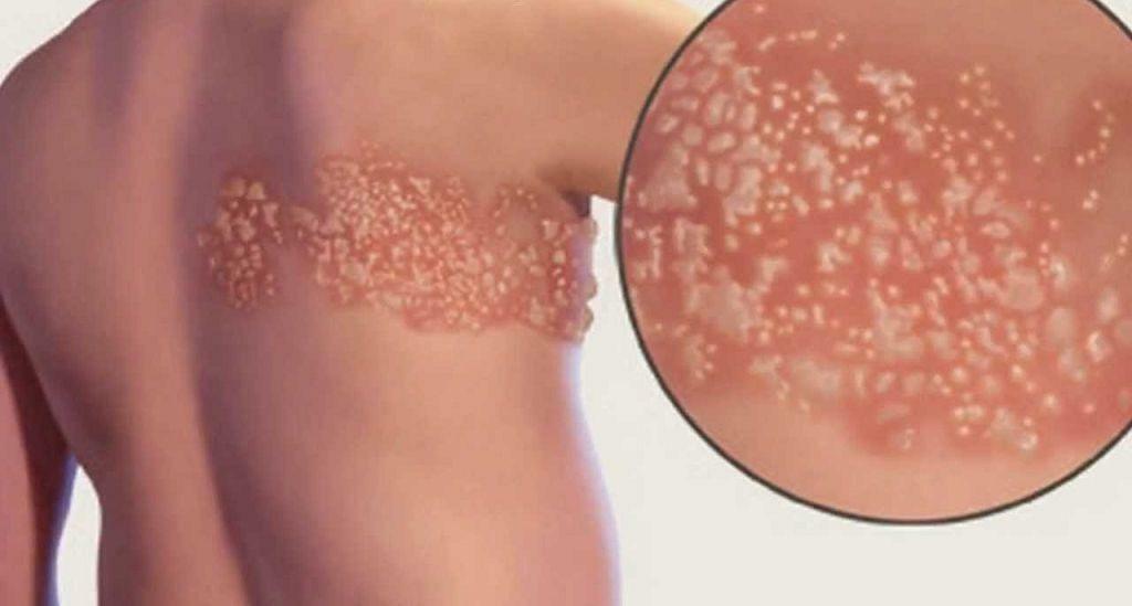 Shingles: treatment at home - detailed information