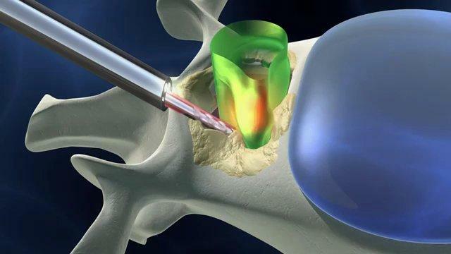 Treatment of stenosis. Surgical methods
