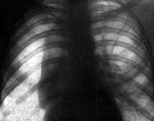 Spontaneous pneumothorax to the right