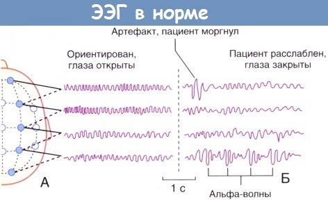EEG (electroencefalografía) en niños. Norma y violaciones, decodificación.
