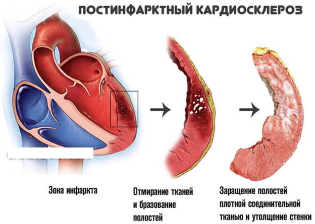 Cicatricialiniai miokardo pokyčiai EKG