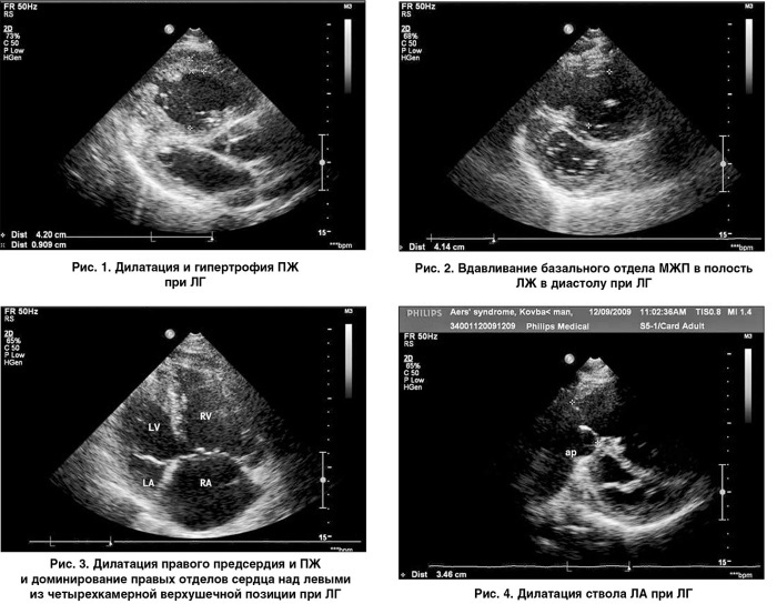 ECHO (echocardiography) of the heart. What shows, normal performance, how they do