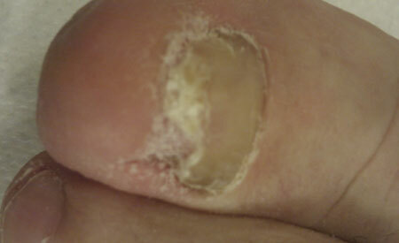 Nail fungus treatment on the big toe