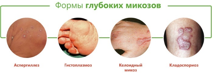 Mycosis of the skin. Photos, symptoms, treatment of the head, face, hands, groin area, drugs