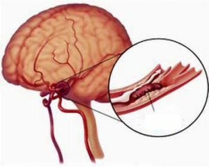 Angioencefalopatija yra pavojinga smegenų kraujagyslių liga