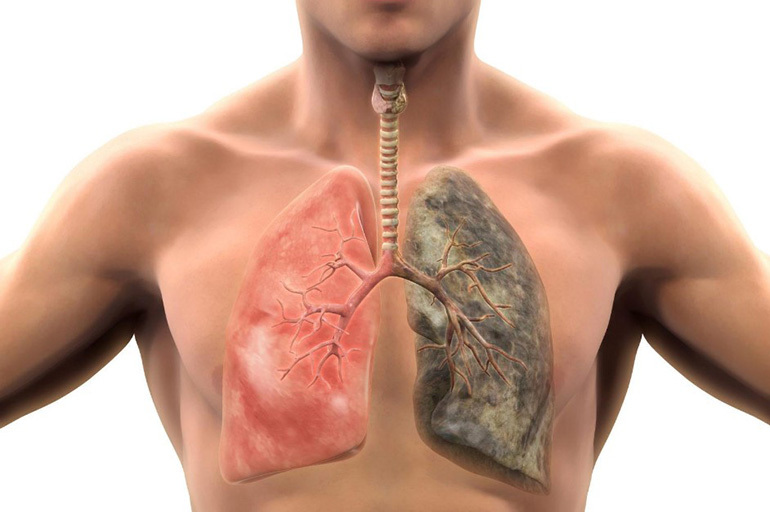 Keuhkotuberkulooma