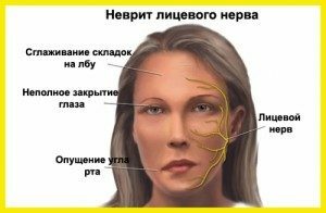 Nevrita nervului facial
